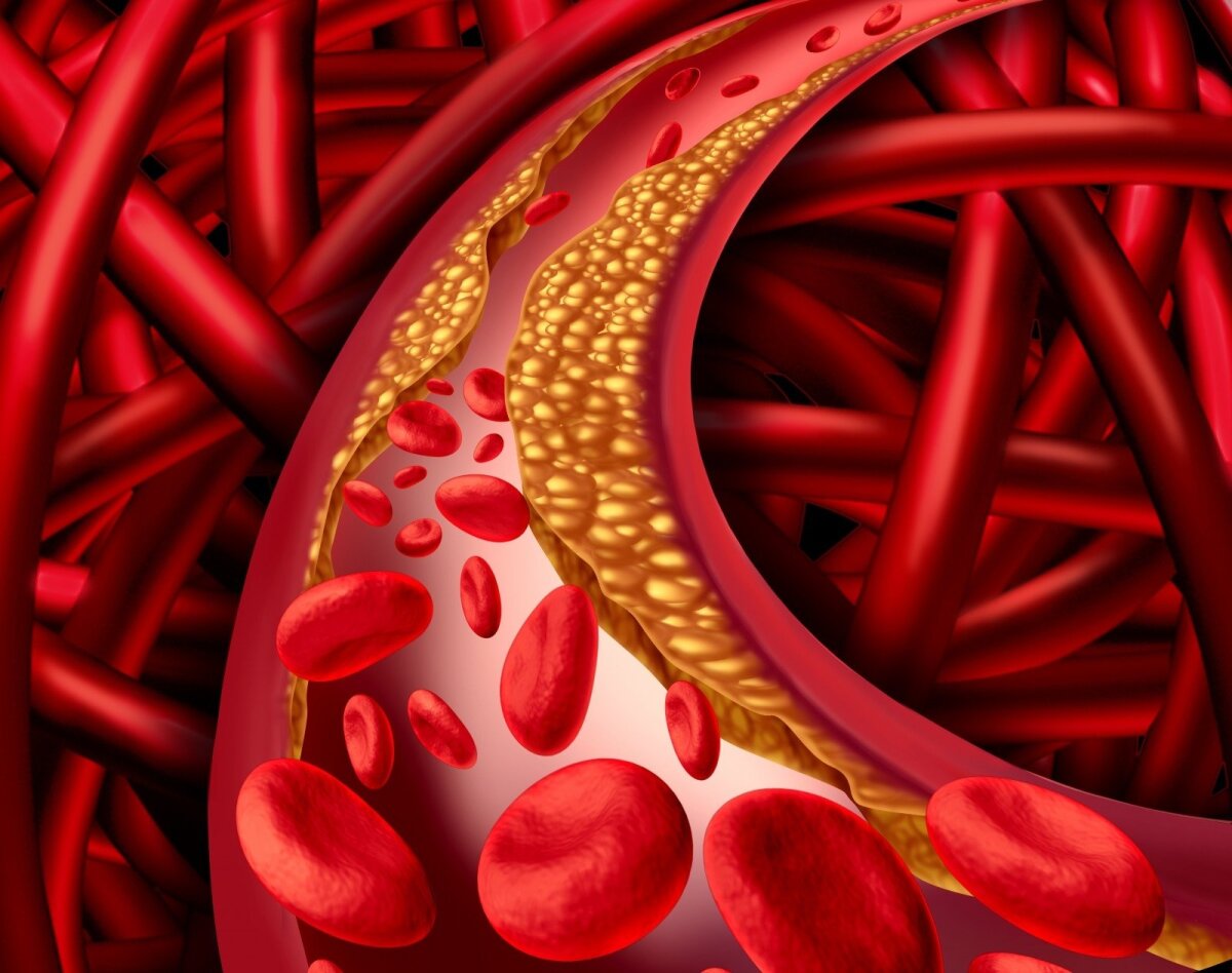 cholesterolio poveikis širdžiai vaistai senyvų žmonių hipertenzijai gydyti