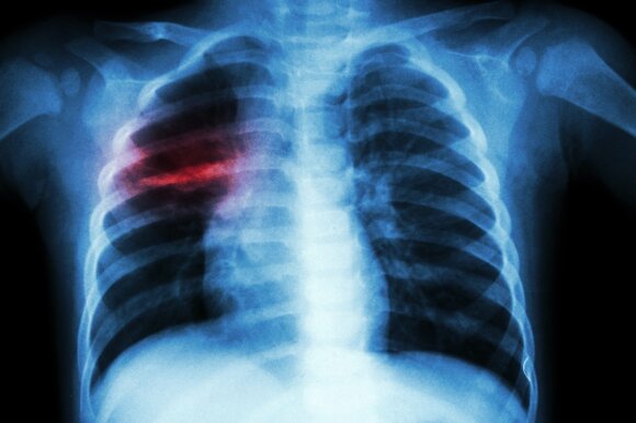 A focus of tuberculosis in the lungs.