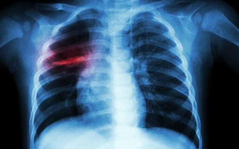 tuberkuliozė