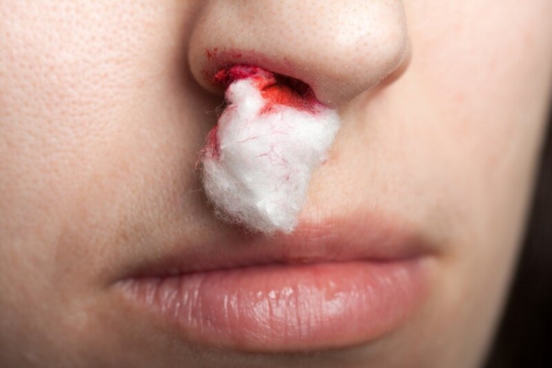 Kraujavimas iš nosies (epistaxis). Simptomai, priežastys, eiga ir gydymas