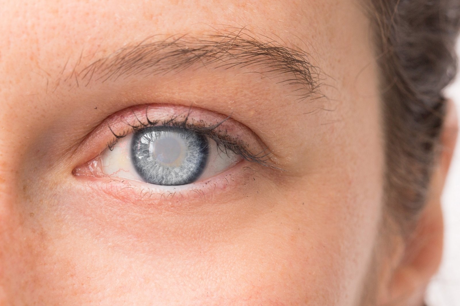 Akių hipertenzija | Akių Gydytojų Praktika